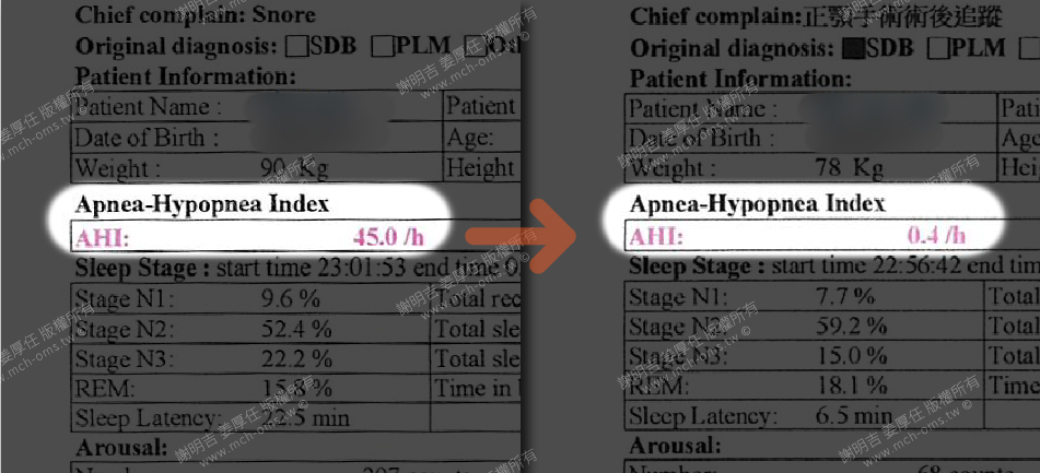28歲男睡眠呼吸中止症治療，正顎手術後AHI大幅下降