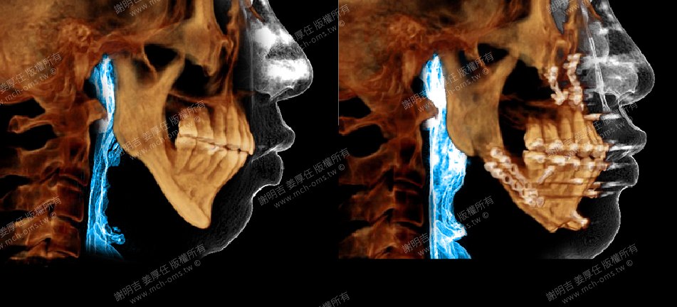 39歲男上下顎骨發育不足往後壓縮