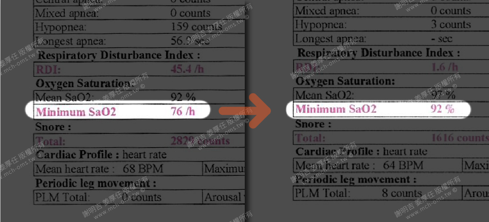 28歲男睡眠呼吸中止症治療，經過正顎手術後SaO2大幅提升
