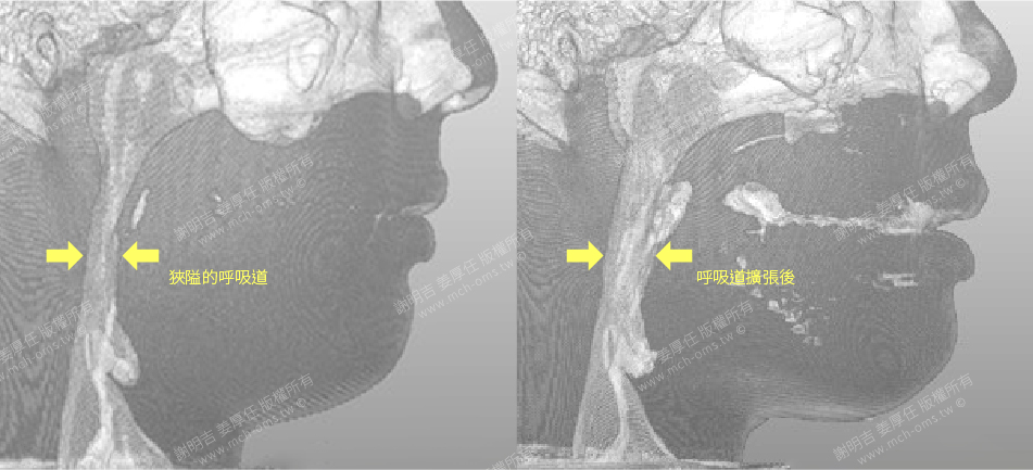 29歲男正顎手術徹底治療呼吸中止症，呼吸道也明顯拓寬了