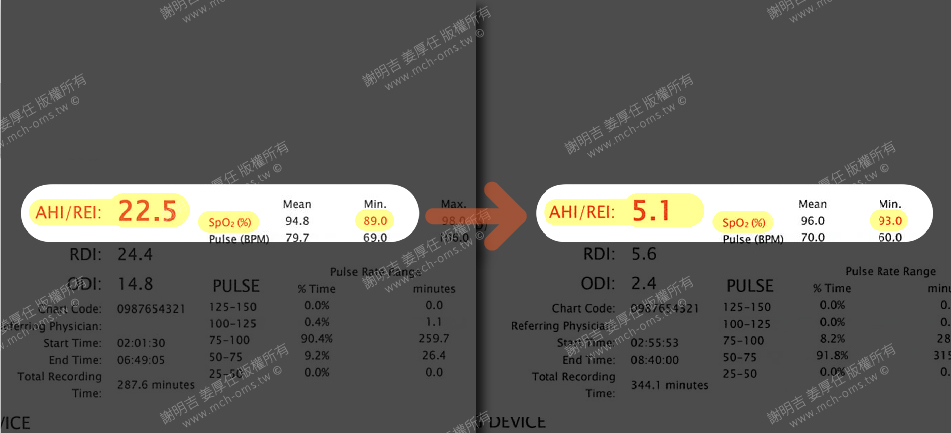 39歲男上下顎骨發育不足往後壓縮，正顎手術後AHI指數大幅下降