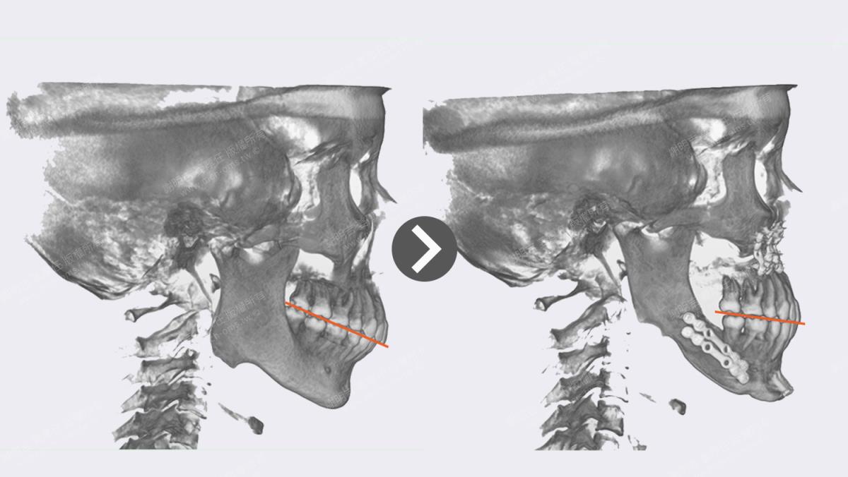 case14 9