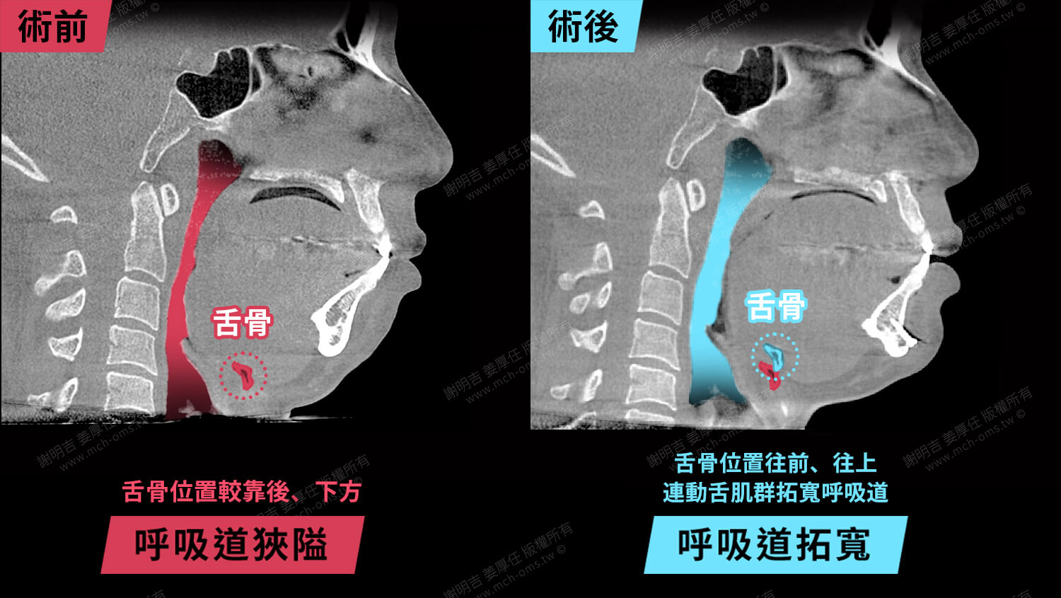 mma case 13 9