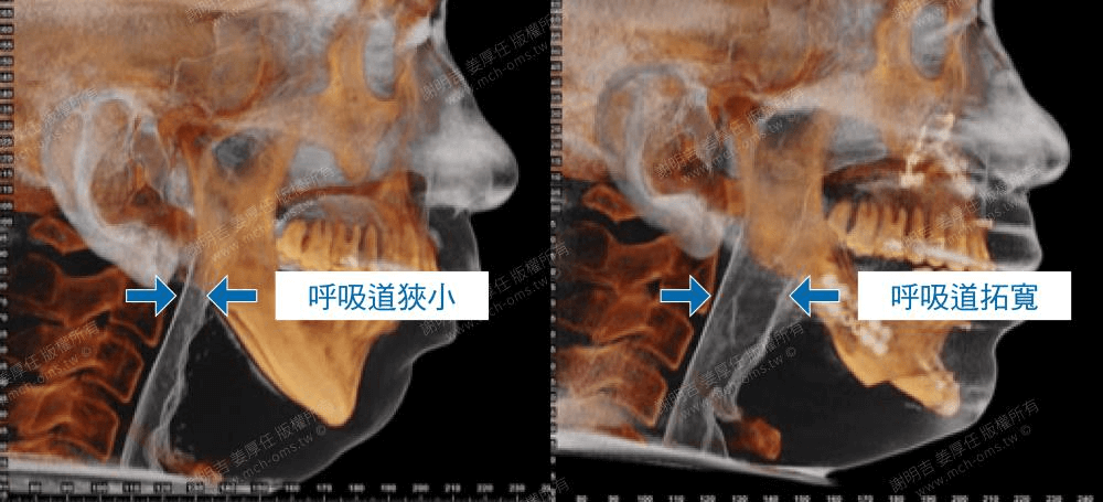 正顎手術可以同時考量到多個阻塞點（multilevelsurgery，多層次手術），並予以改善，甚至還能重塑顏面骨，改善你的臉型