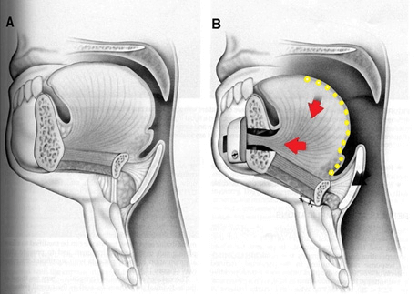 舌底前置術（TONGUE BASE REPOSITIONING）透過把舌頭肌肉往前拉緊的方式，令患者在入睡時，舌底不會往後墜