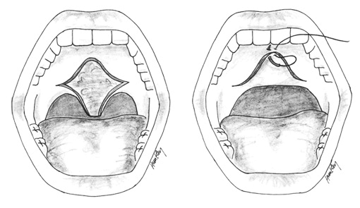 「可恢復型的懸壅腭咽成形術」（Uvulo-Palatal Flap ，UPF），把懸壅垂往上提，以便可以挪出一些可用空間