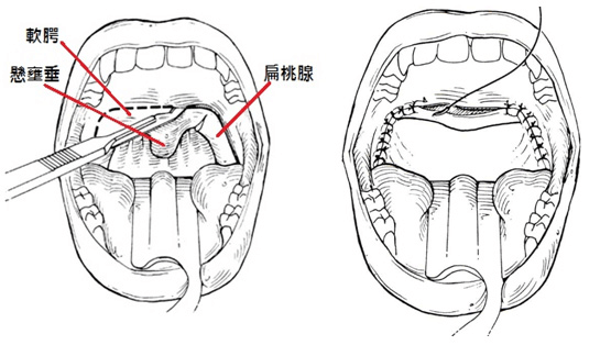 懸壅腭咽成形術（uvulopalatopharyngoplasty，UPPP），就是把懸壅垂和扁桃腺割除，並將部份軟腭減短，令口腔空間看起來變大